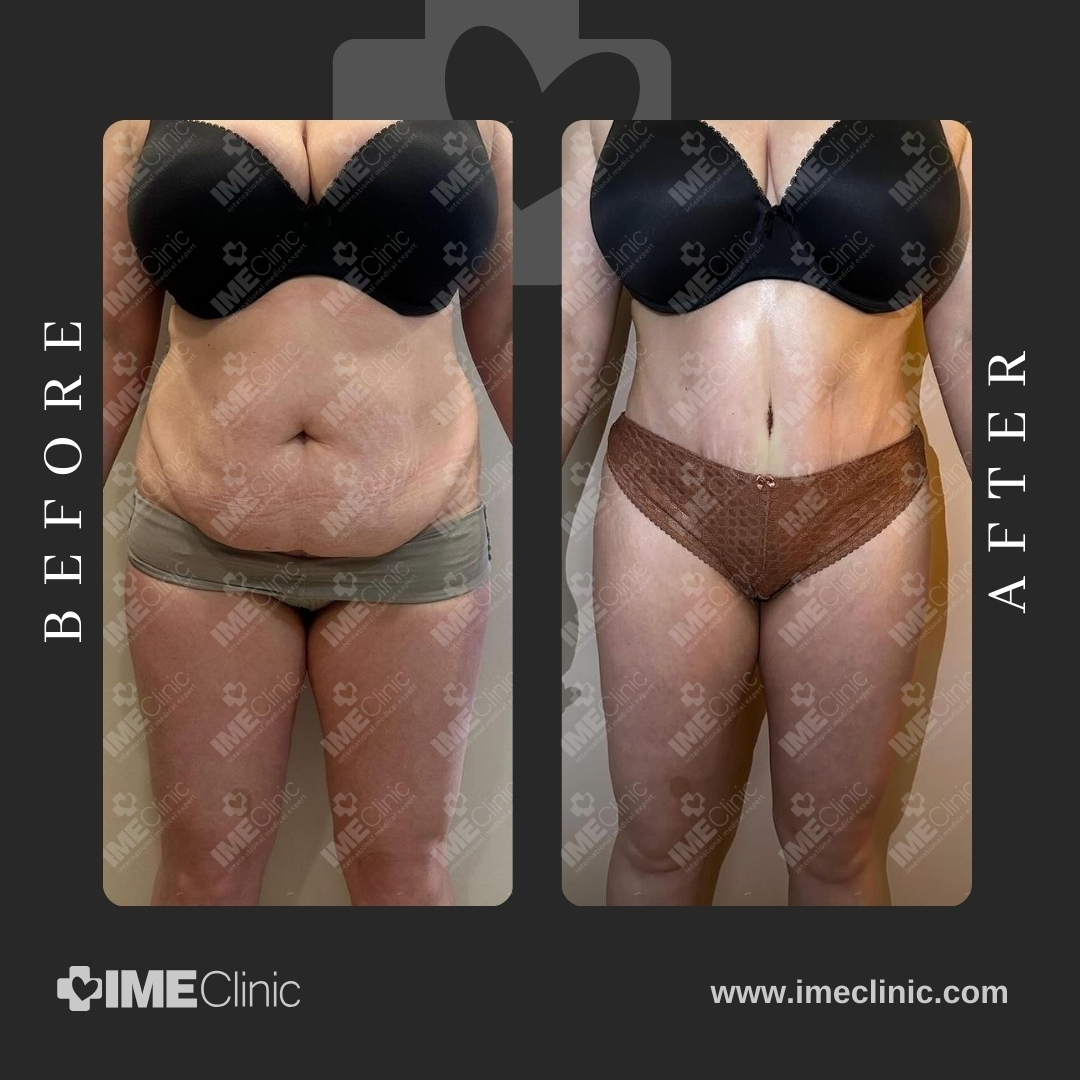 
                                     Before-and-after comparison of a person in underwear. The left image shows a side with more visible abdominal fullness. The right image shows a more contoured midsection. Both images have a watermark and the text IME Clinic is visible.